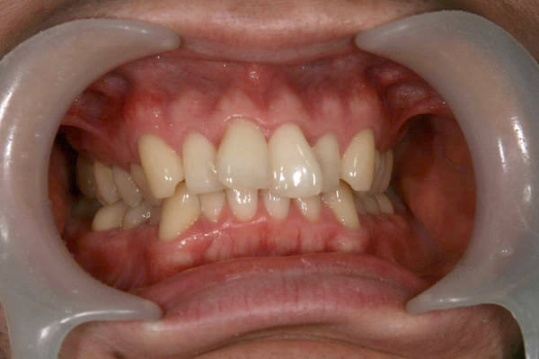 矯正歯科　－ 症例6 －